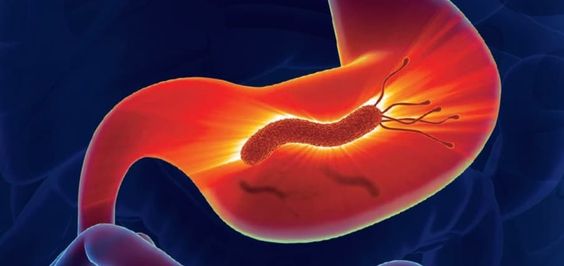 Stomach (Peptic) Ulcer: Signs, Symptoms, Causes & Treatment
